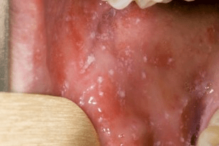 Close-up image of the interior of a mouth showing small white lesions, known as Koplik spots, typically indicating a measles infection.