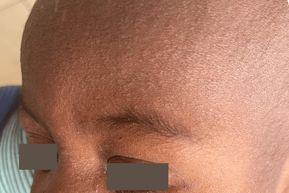 Close-up of a child's forehead showing skin texture, indicating potential measles rash.