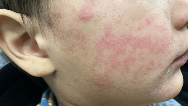 Close-up of a child's face showing a red and blotchy rash, typical of measles.