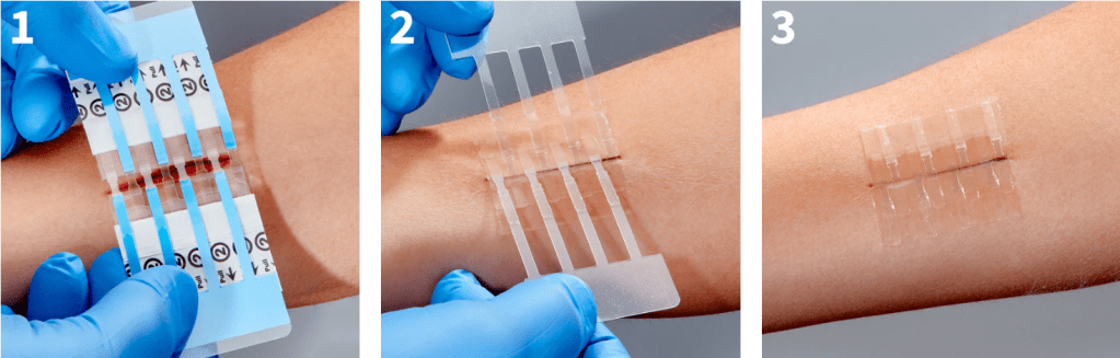 A series of images showing the application process of the Clozex wound closure system on a forearm. The first image depicts the device being positioned over a laceration. The second image shows the device being pressed down to secure its placement. The third image displays the completed closure, highlighting the neat, scarring-minimizing design.