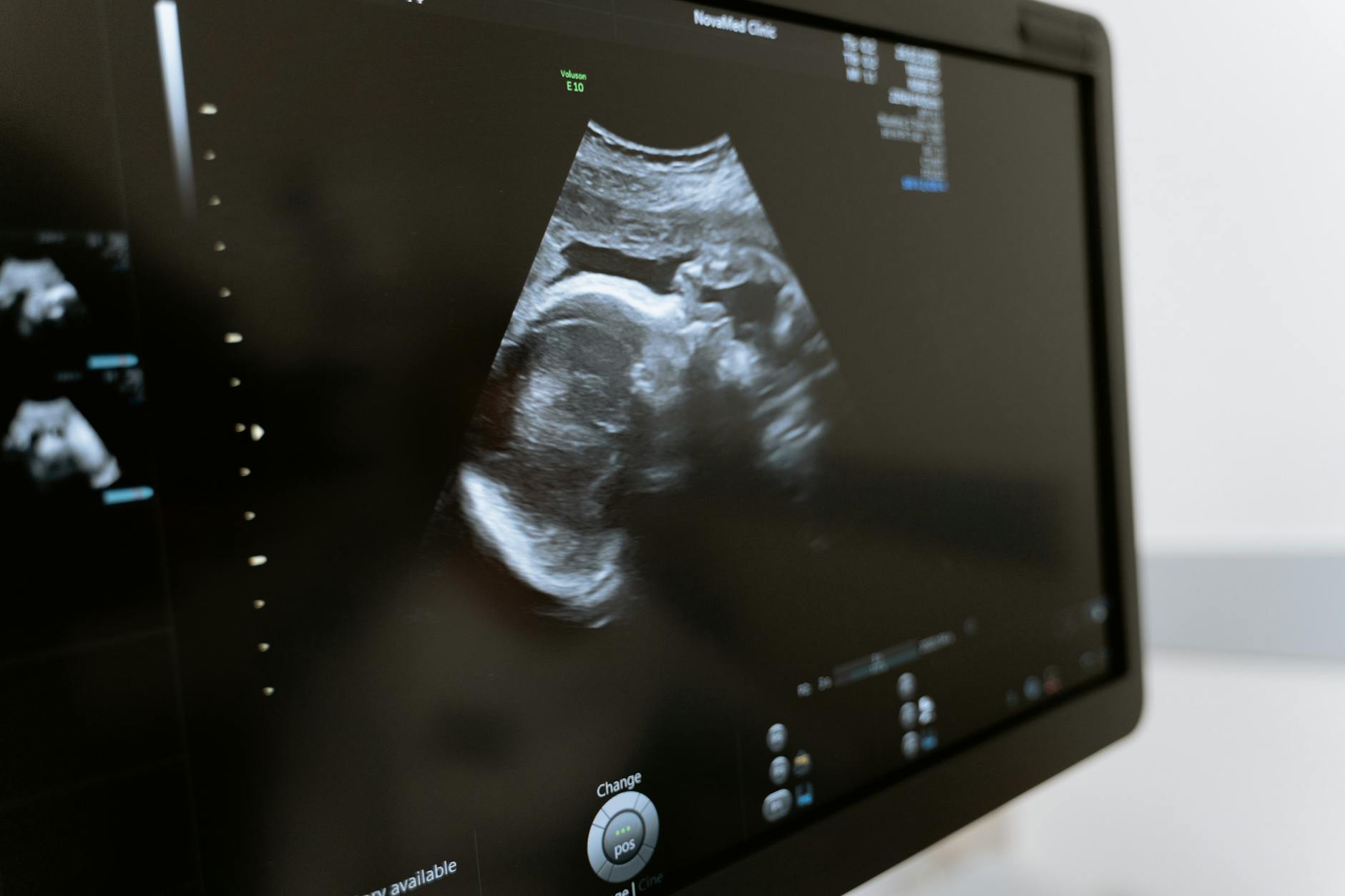 Ultrasound image showing an unborn baby, highlighting prenatal healthcare advancements.