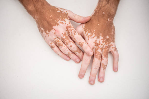 Hands with visible vitiligo patches resting against a light background.